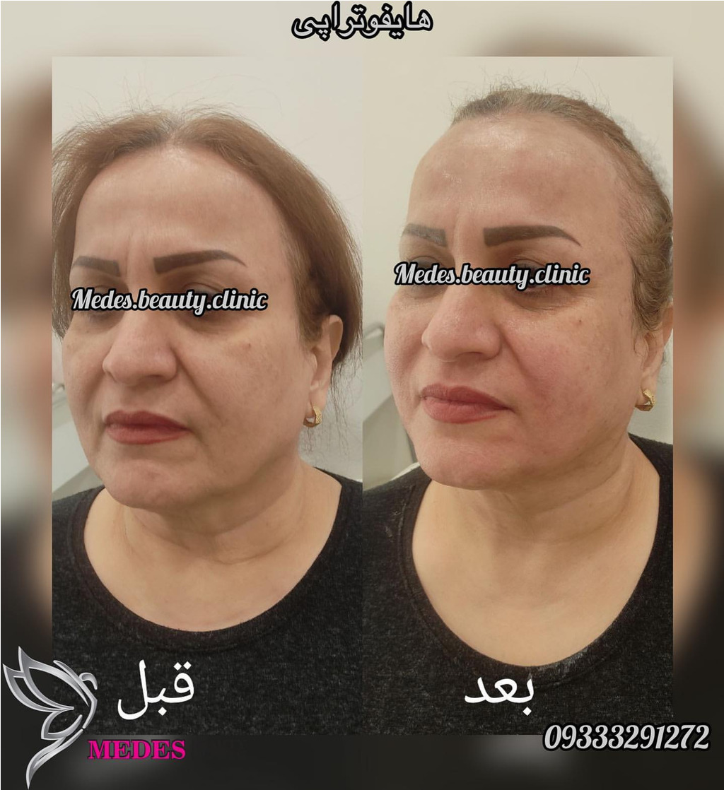 هایفوتراپی