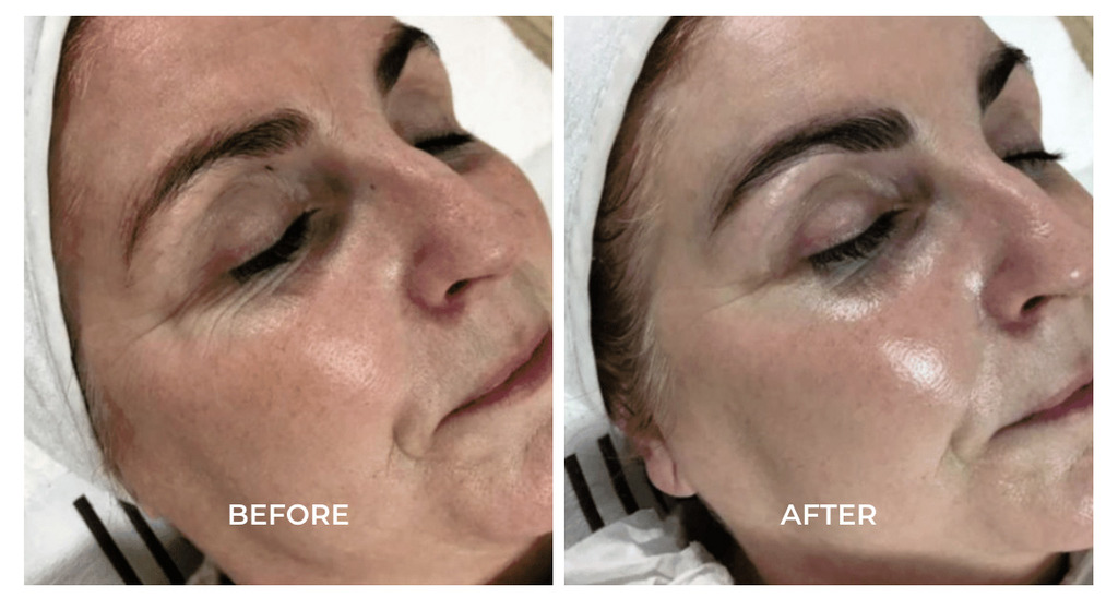 کربوکسی تراپی در کلینیک مدس کرج