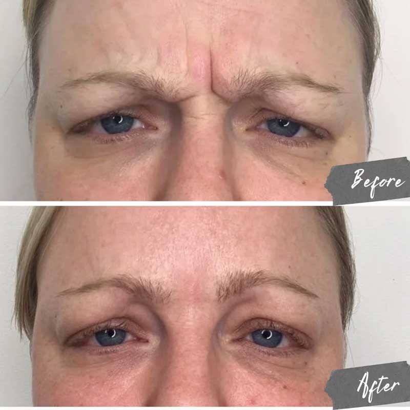 بوتاکس خط اخم