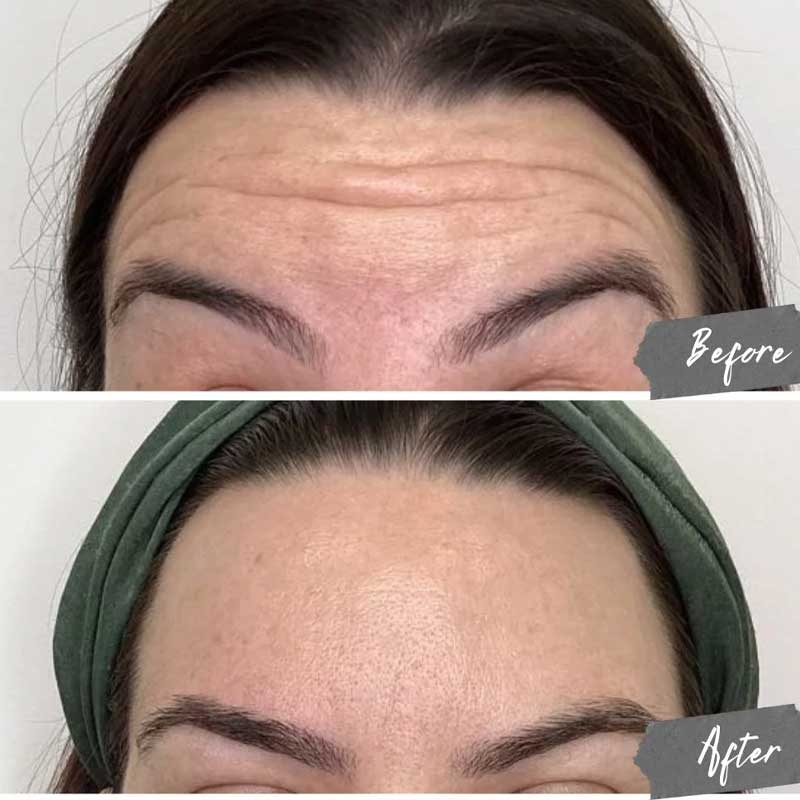 بوتاکس پیشانی