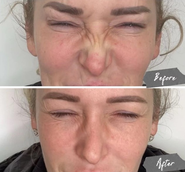 درمان بوتاکس بانی لاین