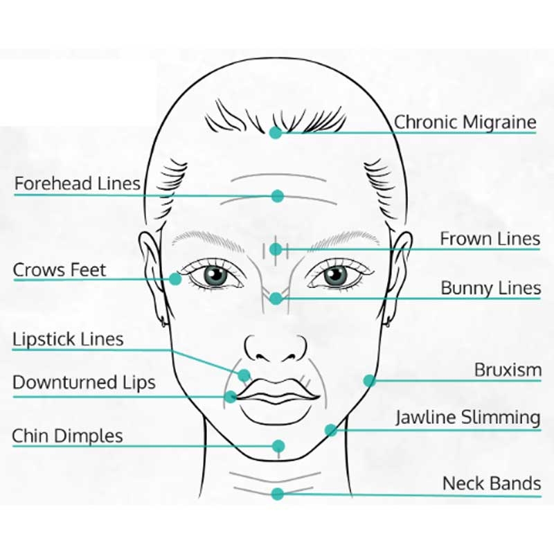 کاربردهای بوتاکس