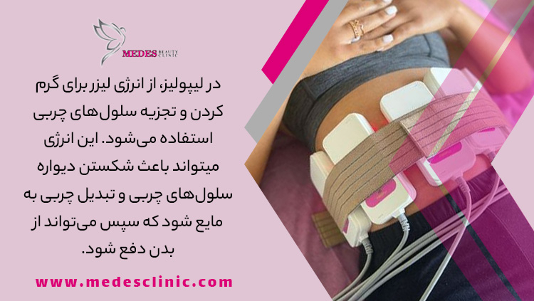 مزایای دستگاه لیپولیز