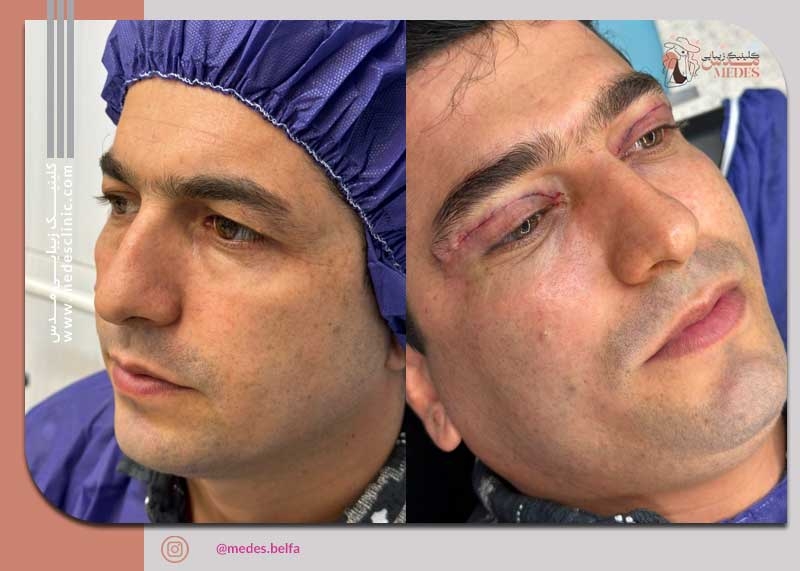 بلفاروپلاستی در کرج