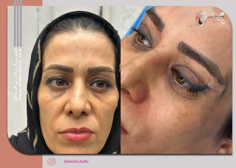 بلفاروپلاستی کرج عمل