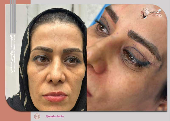 گالری بلفاروپلاستی و جراحی پلک