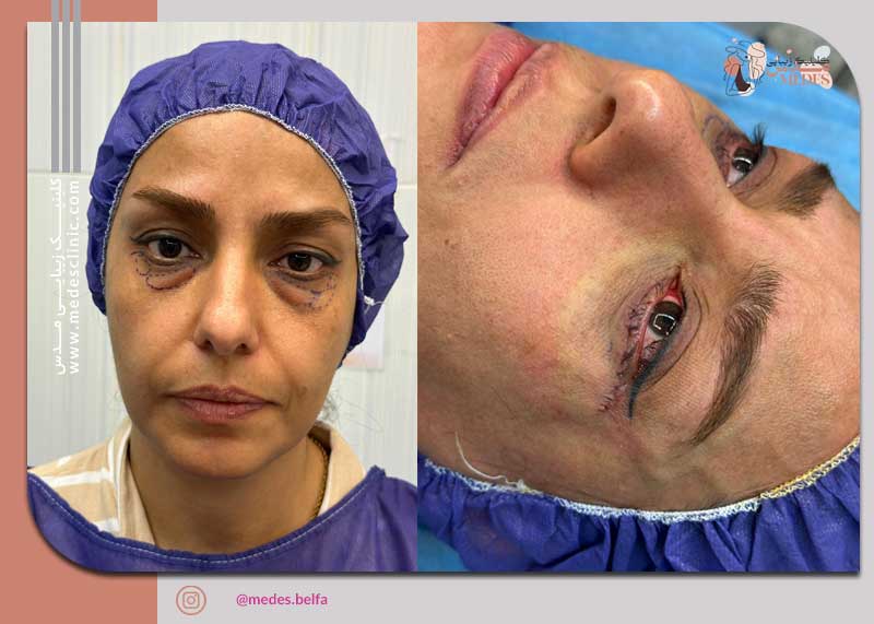 گالری بلفاروپلاستی و جراحی پلک