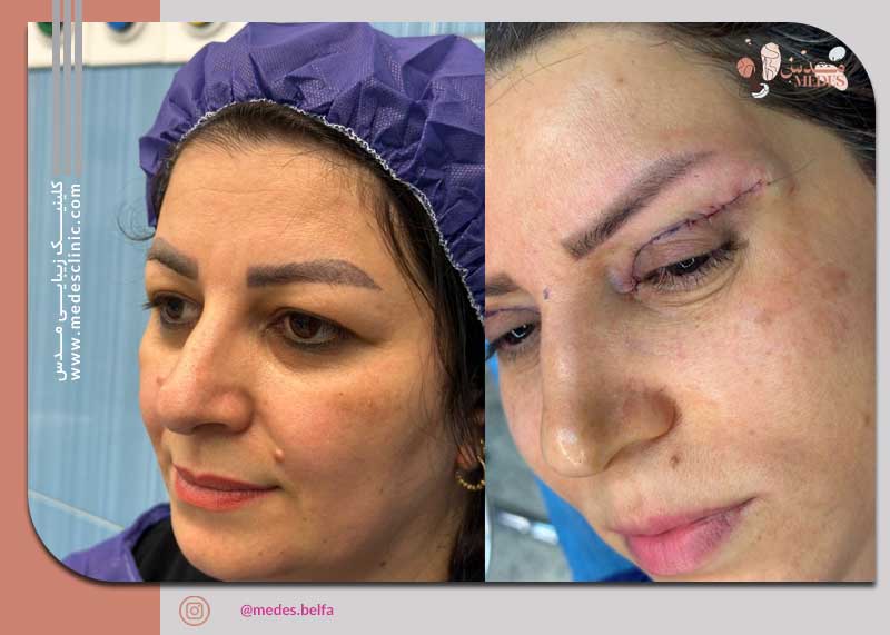 گالری بلفاروپلاستی و جراحی پلک