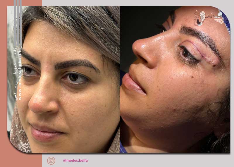 گالری بلفاروپلاستی و جراحی پلک