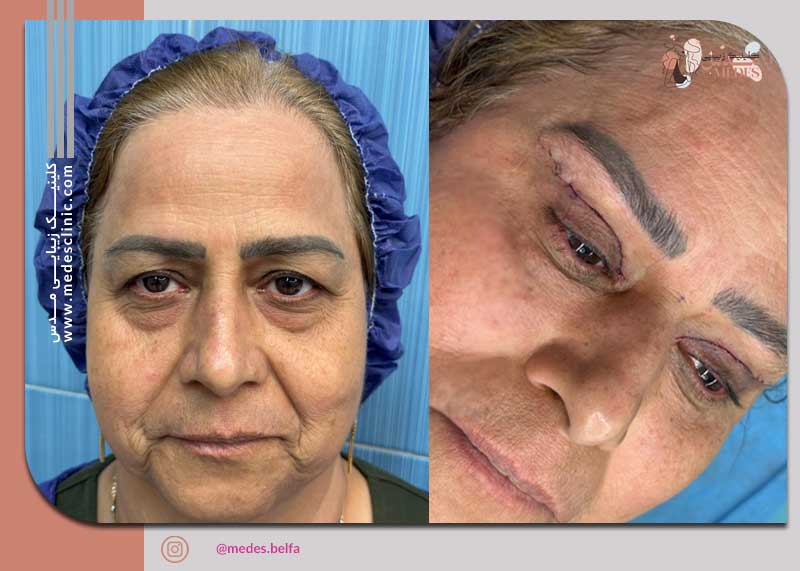 گالری بلفاروپلاستی و جراحی پلک