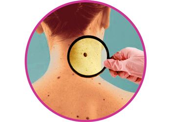 برداشت خال و زگیل