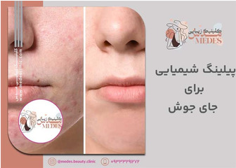 پیلینگ شیمیایی برای جای جوش