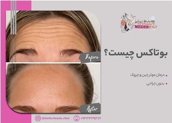 بوتاکس چیست؟