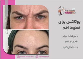 راه حل های موثر برای خطوط اخم