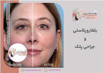 بلفاروپلاستی و جراحی پلک