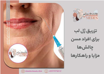 تزریق ژل لب برای افراد مسن: چالش‌ها، مزایا و راهکارها