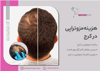 مزوتراپی مو