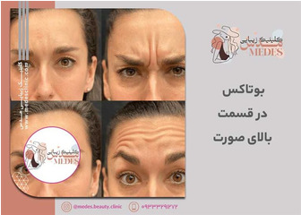 بوتاکس در قسمت بالای صورت