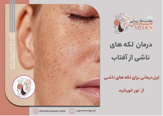 لیزر درمانی برای لکه های ناشی از آفتاب
