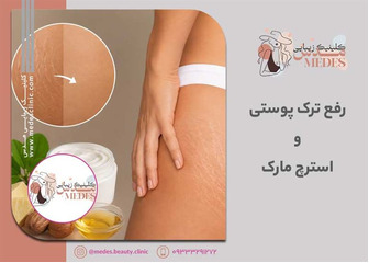 رفع ترک پوستی و استرچ مارک در کرج