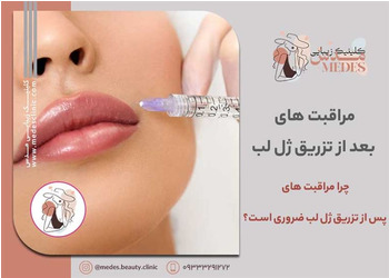 مراقبت‌ های بعد از تزریق ژل لب