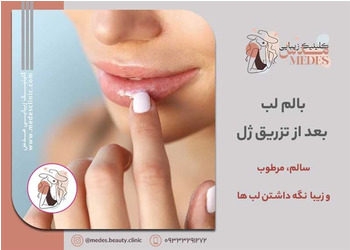 بالم لب بعد از تزریق ژل