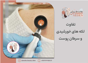 تفاوت لکه های خورشیدی و سرطان پوست