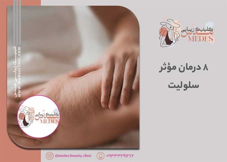 ۸ درمان مؤثر سلولیت در ۲۰۲۵