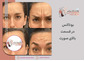 بوتاکس در قسمت بالای صورت