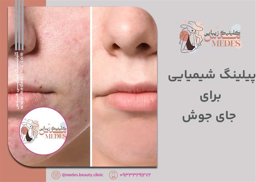 پیلینگ شیمیایی برای جای جوش