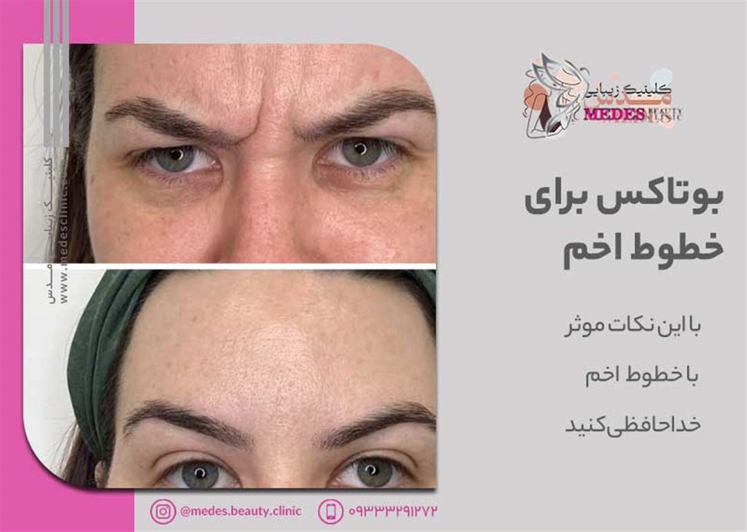 با این نکات موثر با خطوط اخم خداحافظی کنید