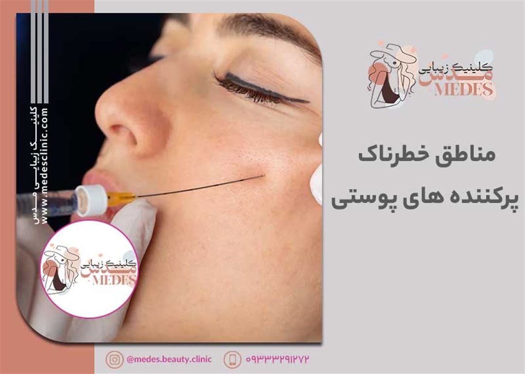 مناطق پرخطر تزریق فیلرهای پوستی: نقاط ممنوعه تزریق ژل