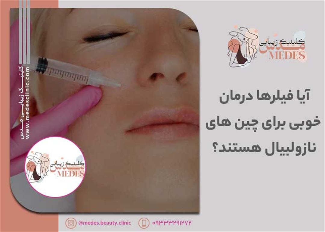 آیا فیلرهای پوستی برای چینهای نازولبیال مؤثر هستند؟