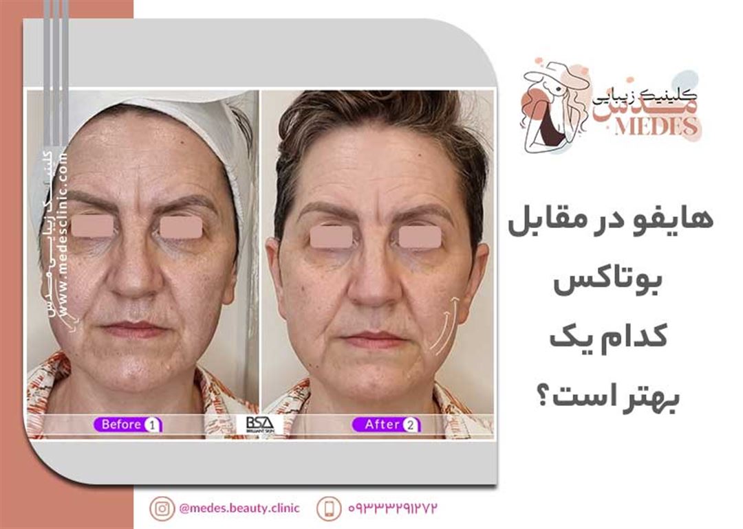 هایفو در مقابل بوتاکس – کدام یک بهتر است؟ (نتایج، مزایا و عوارض جانبی)