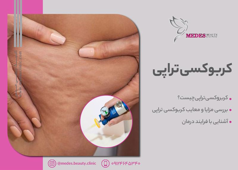 کربوکسی تراپی در کرج | هزینه های کربوکسی تراپی در کرج