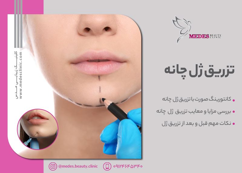 زاویه سازی صورت کرج | بهترین دکتر زاویه سازی صورت در کرج