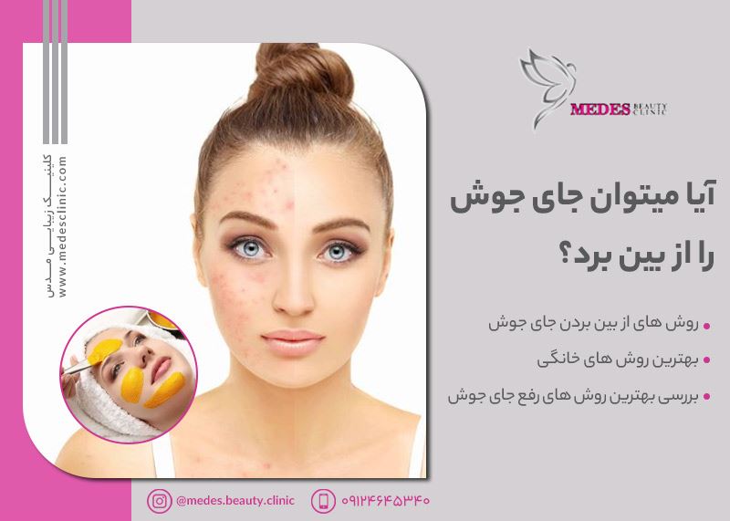 آیا میتوان جای جوش را از بین برد؟