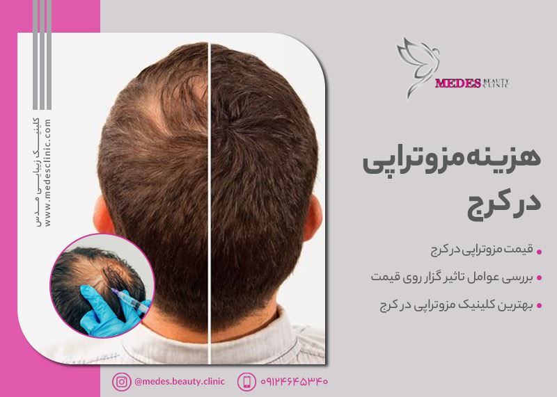 هزینه مزوتراپی مو | بهترین دکتر مزوتراپی در کرج