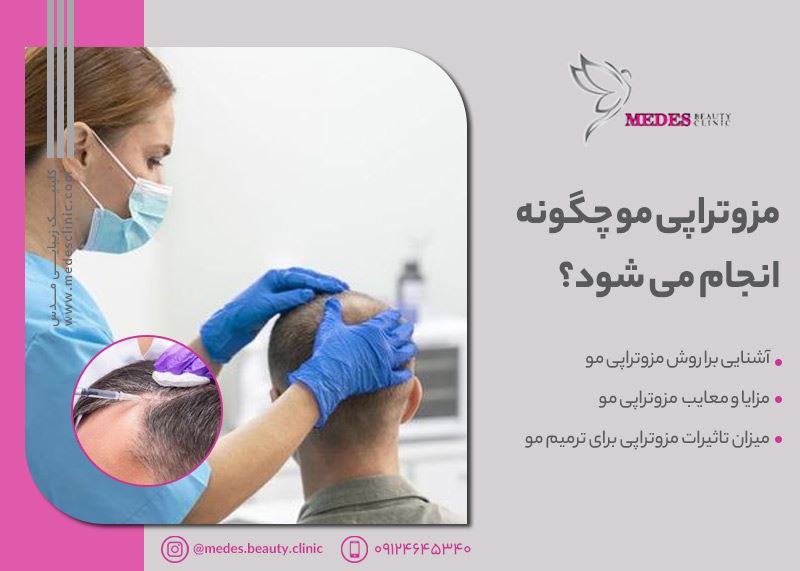 مزوتراپی مو چگونه انجام میشود؟