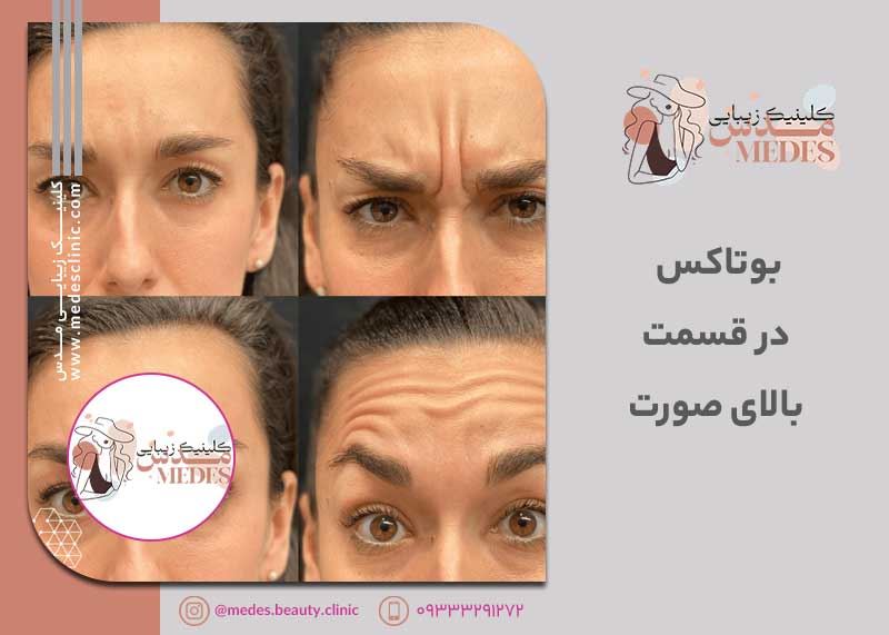 راهنمای جامع: بوتاکس در قسمت بالای صورت