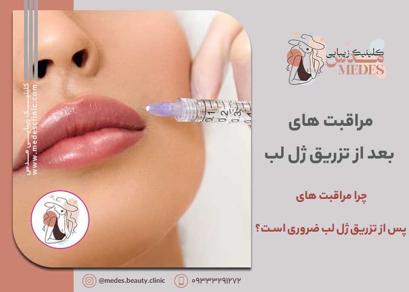 مراقبت‌ های بعد از تزریق ژل لب