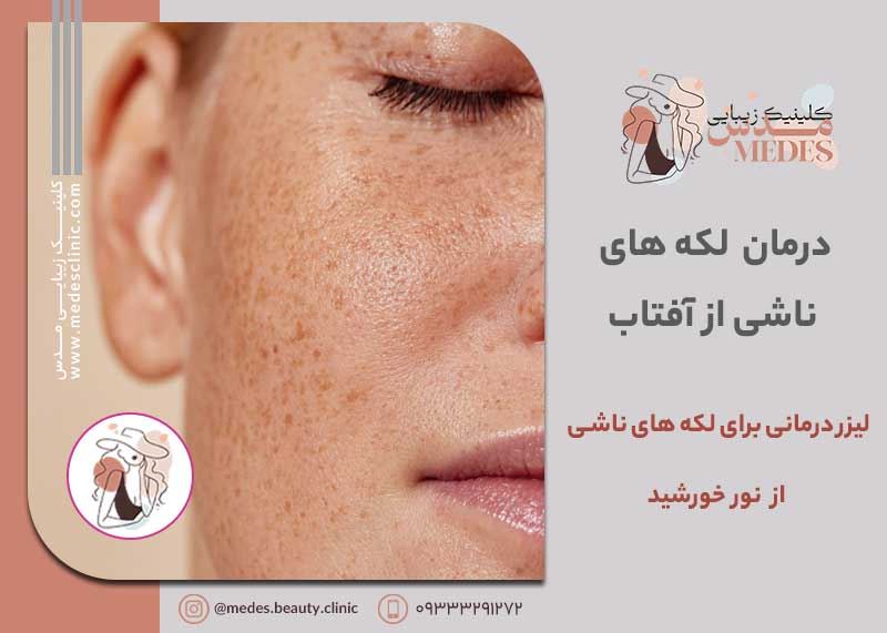 لیزر درمانی برای لکه های ناشی از آفتاب