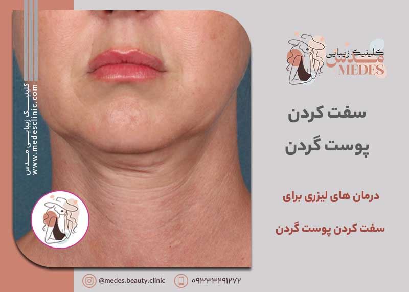 درمان های لیزری برای سفت کردن پوست گردن