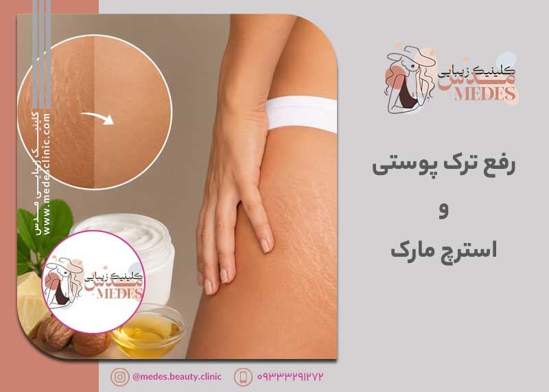رفع ترک پوستی و استرچ مارک در کرج