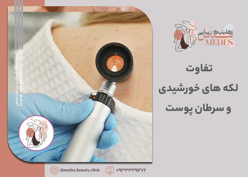 تفاوت لکه های خورشیدی و سرطان پوست