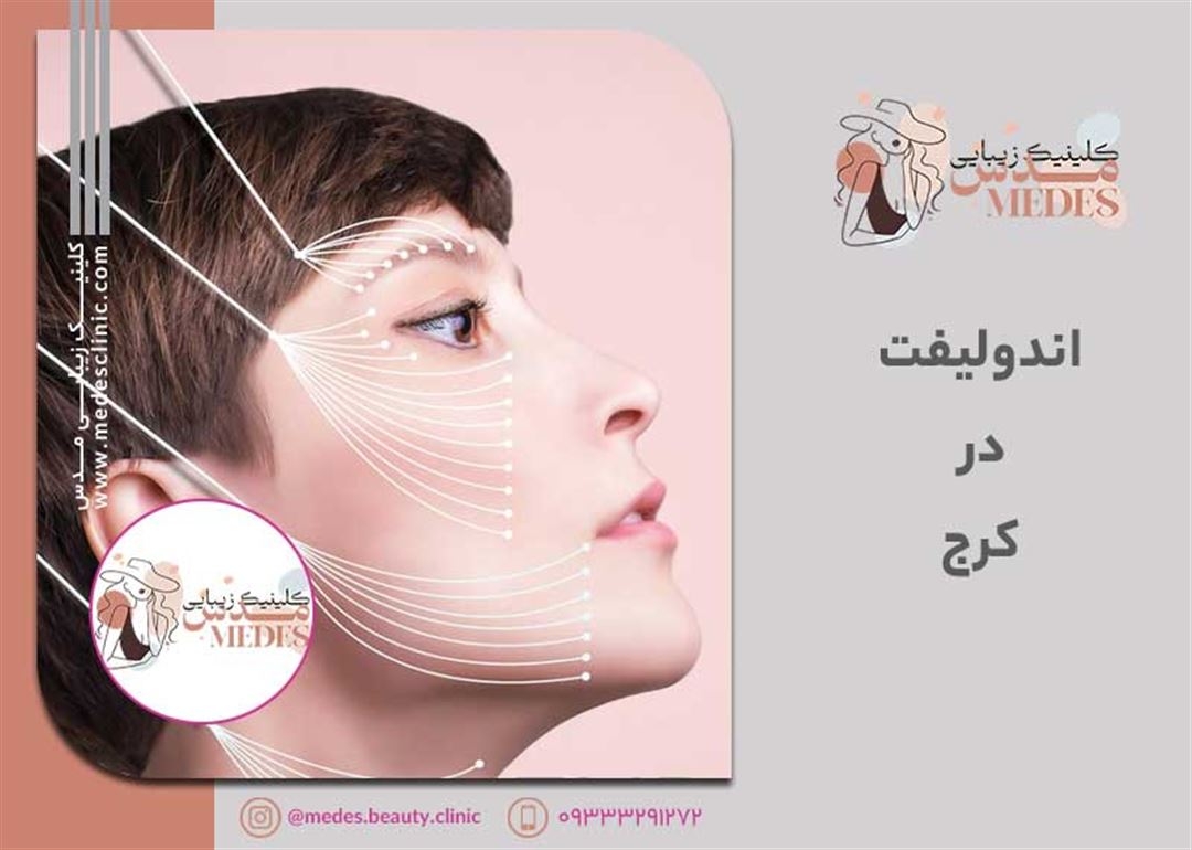 بهترین مرکز اندولیفت در کرج کجاست؟ معرفی کامل خدمات و نتایج