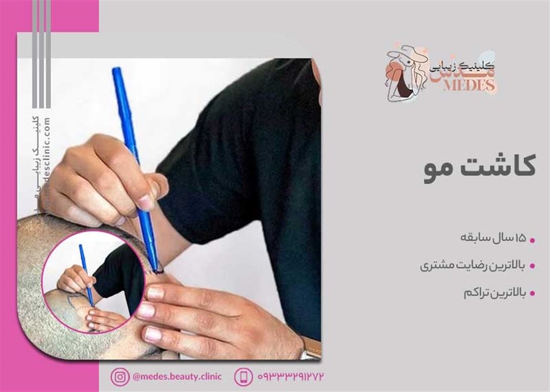 کاشت مو کرج | بهترین کلینیک کاشت مو در کرج از نظر مردم